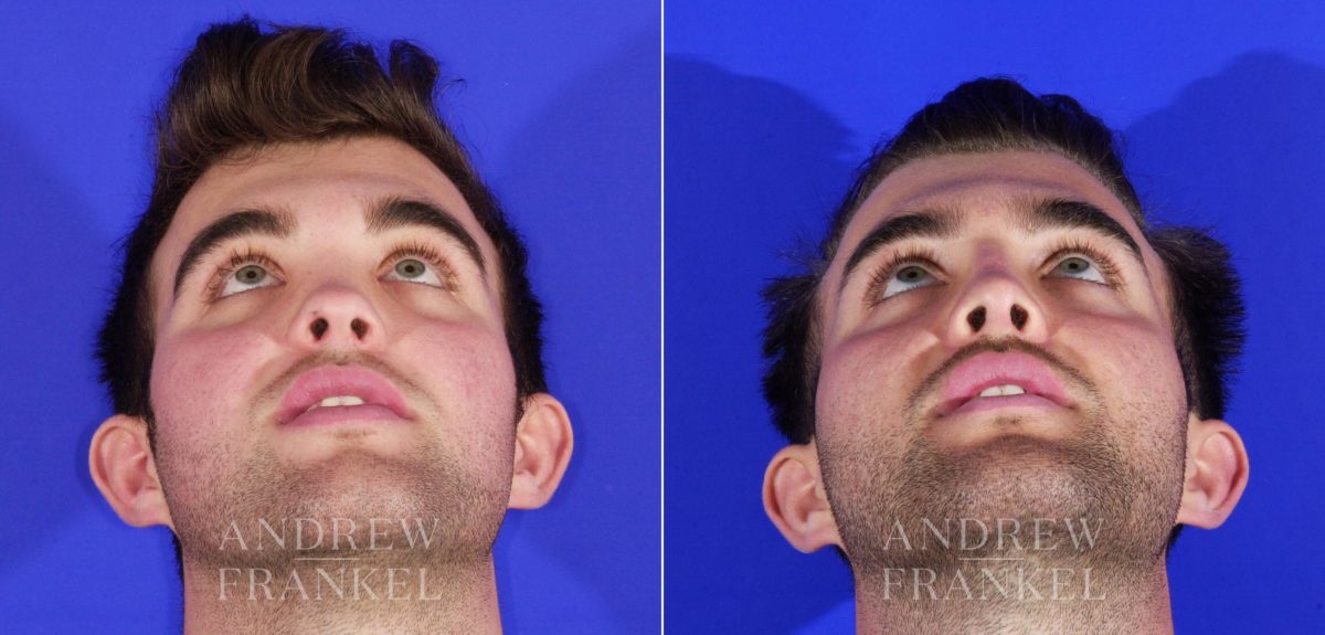 Rhinoplasty before and after photos in Beverly Hills, CA, Patient 13049