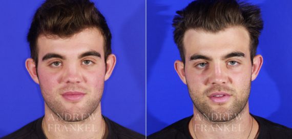 Rhinoplasty before and after photos in Beverly Hills, CA, Patient 13049