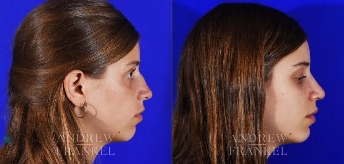 Rhinoplasty before and after photos in Beverly Hills, CA, Patient 13069