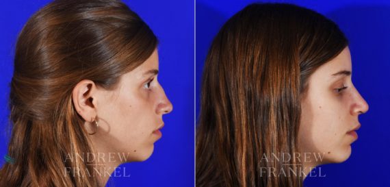 Rhinoplasty before and after photos in Beverly Hills, CA, Patient 13069