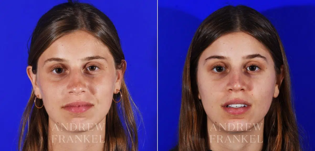 Rhinoplasty before and after photos in Beverly Hills, CA, Patient 13069