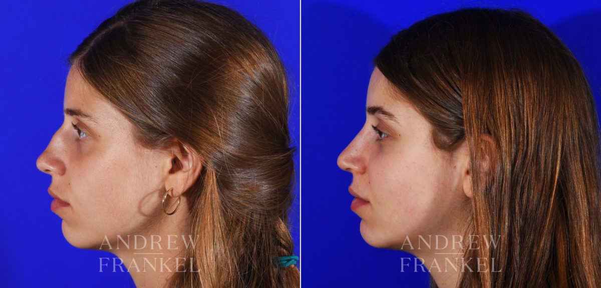 Rhinoplasty before and after photos in Beverly Hills, CA, Patient 13069