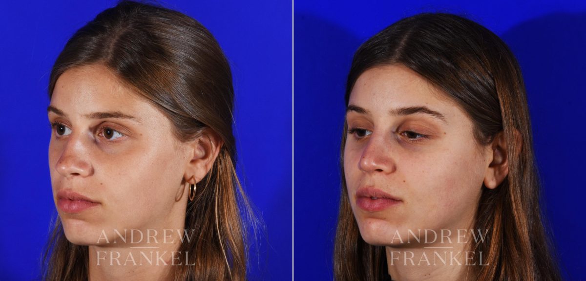 Rhinoplasty before and after photos in Beverly Hills, CA, Patient 13069