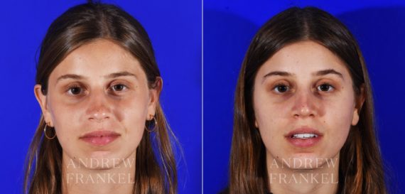 Rhinoplasty before and after photos in Beverly Hills, CA, Patient 13069