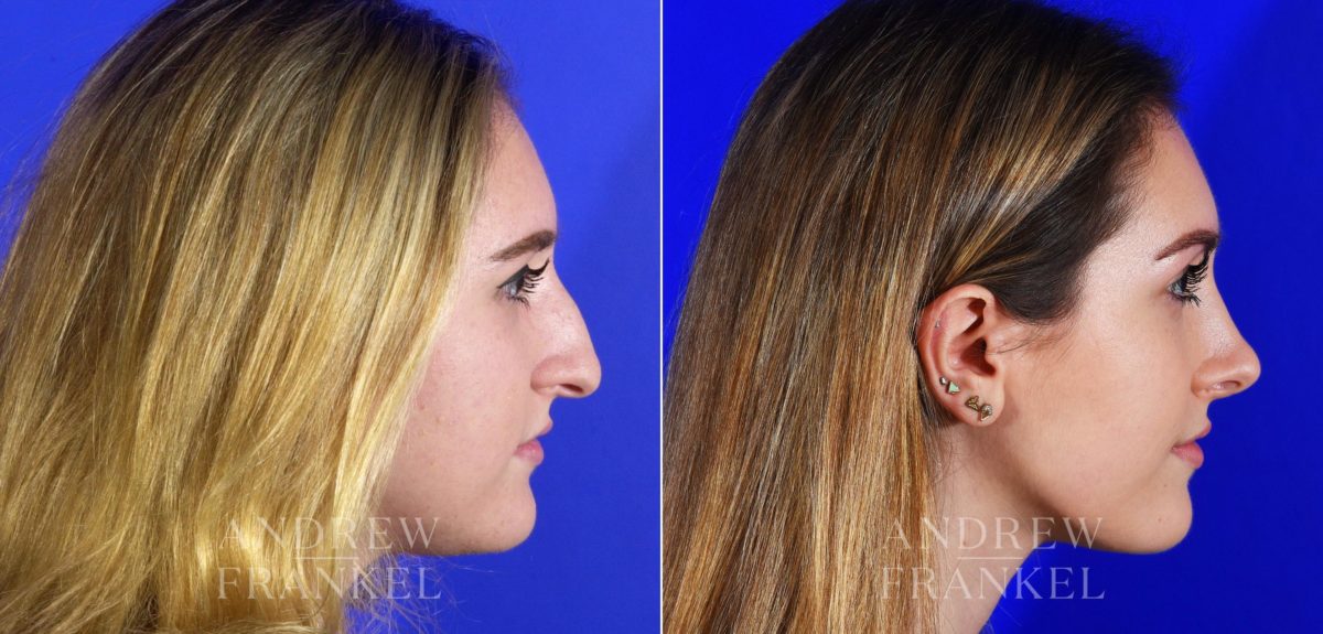 Rhinoplasty before and after photos in Beverly Hills, CA, Patient 13095
