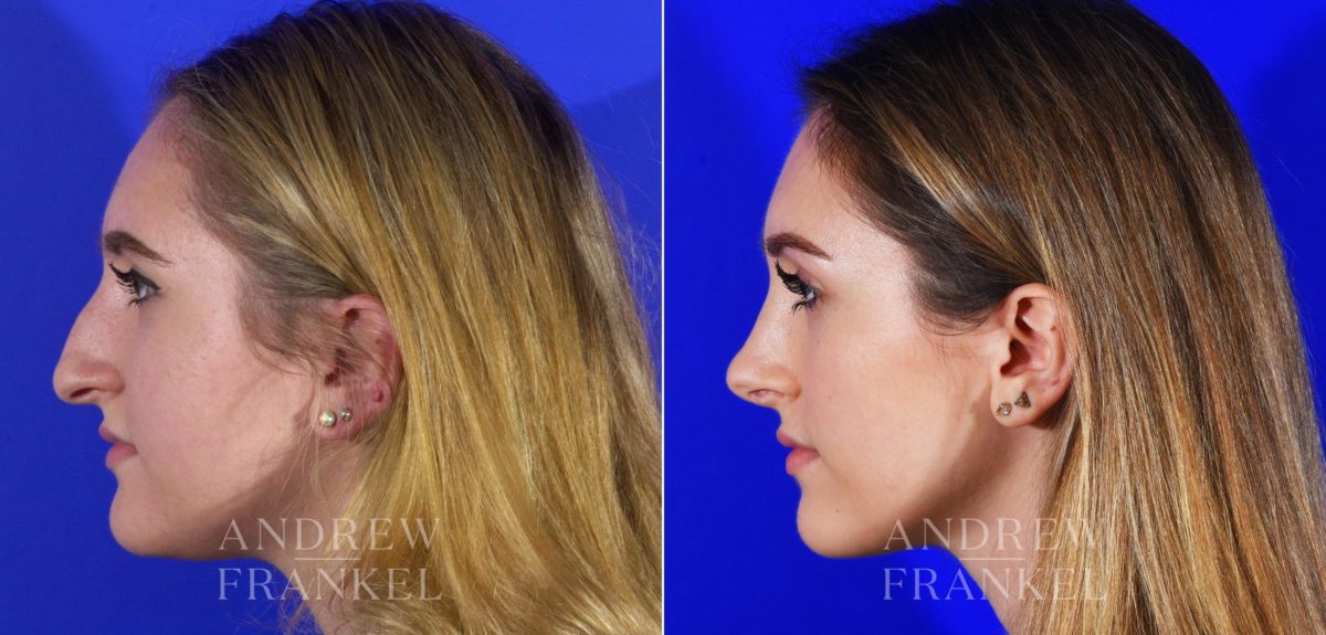 Rhinoplasty before and after photos in Beverly Hills, CA, Patient 13095