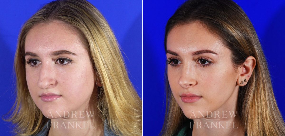 Rhinoplasty before and after photos in Beverly Hills, CA, Patient 13095