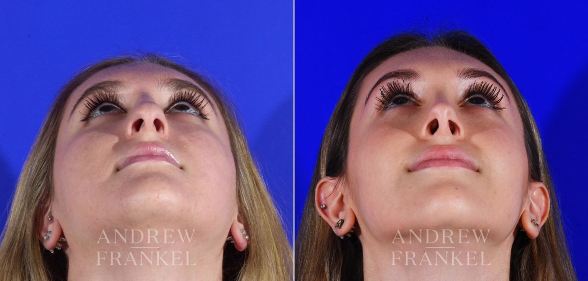 Rhinoplasty before and after photos in Beverly Hills, CA, Patient 13095
