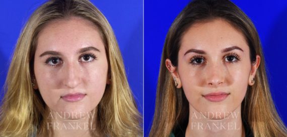 Rhinoplasty before and after photos in Beverly Hills, CA, Patient 13095