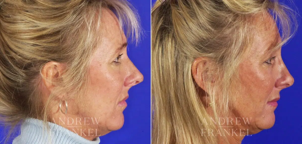 Rhinoplasty before and after photos in Beverly Hills, CA, Patient 13115