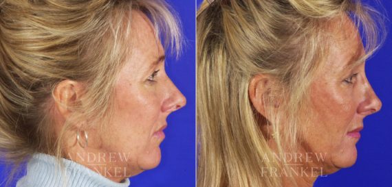 Rhinoplasty before and after photos in Beverly Hills, CA, Patient 13115
