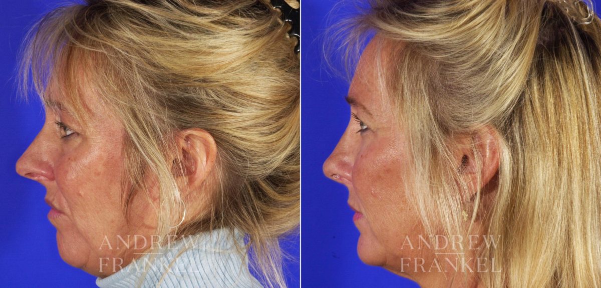 Rhinoplasty before and after photos in Beverly Hills, CA, Patient 13115