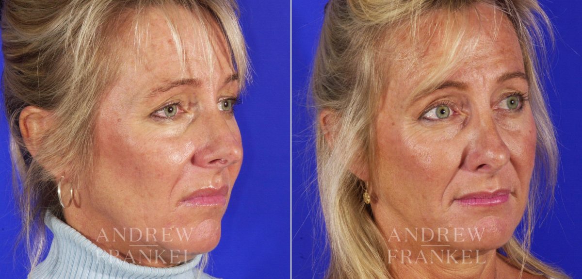 Rhinoplasty before and after photos in Beverly Hills, CA, Patient 13115
