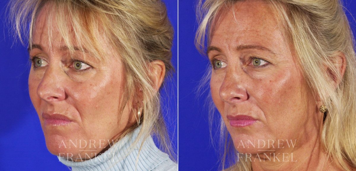 Rhinoplasty before and after photos in Beverly Hills, CA, Patient 13115
