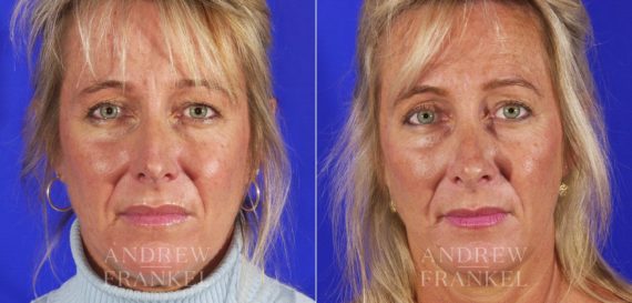 Rhinoplasty before and after photos in Beverly Hills, CA, Patient 13115