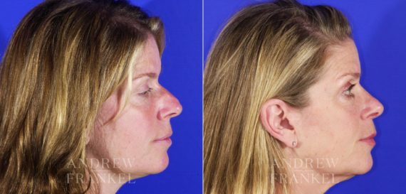 Rhinoplasty before and after photos in Beverly Hills, CA, Patient 13135
