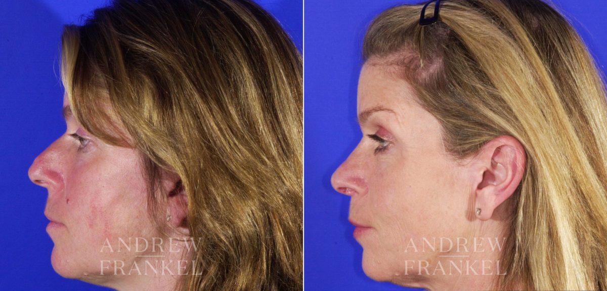 Rhinoplasty before and after photos in Beverly Hills, CA, Patient 13135