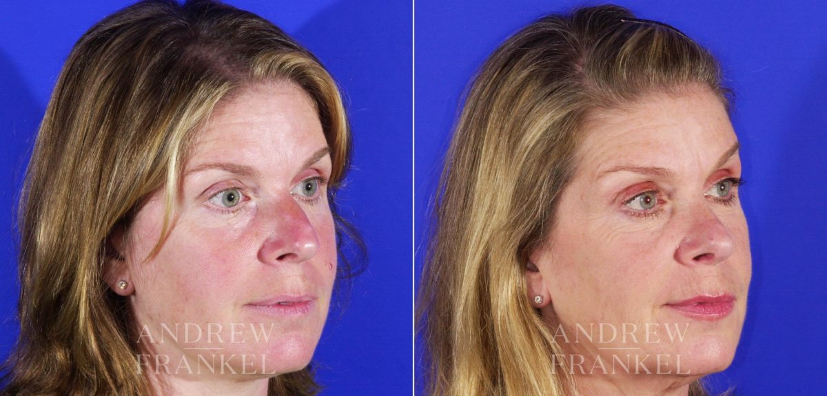 Rhinoplasty before and after photos in Beverly Hills, CA, Patient 13135