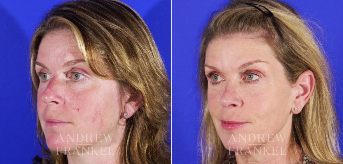 Rhinoplasty before and after photos in Beverly Hills, CA, Patient 13135
