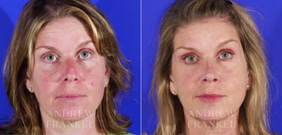 Rhinoplasty before and after photos in Beverly Hills, CA, Patient 13135