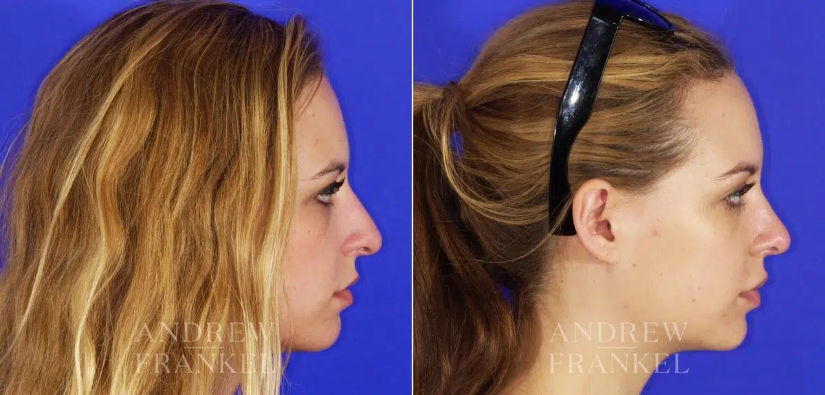 Rhinoplasty before and after photos in Beverly Hills, CA, Patient 13344