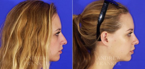 Rhinoplasty before and after photos in Beverly Hills, CA, Patient 13344