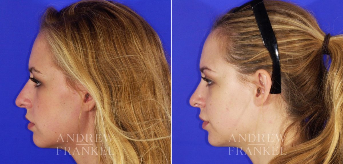 Rhinoplasty before and after photos in Beverly Hills, CA, Patient 13344