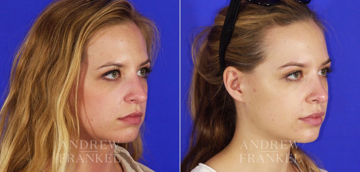 Rhinoplasty before and after photos in Beverly Hills, CA, Patient 13344