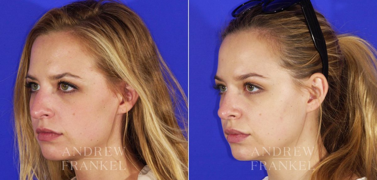 Rhinoplasty before and after photos in Beverly Hills, CA, Patient 13344