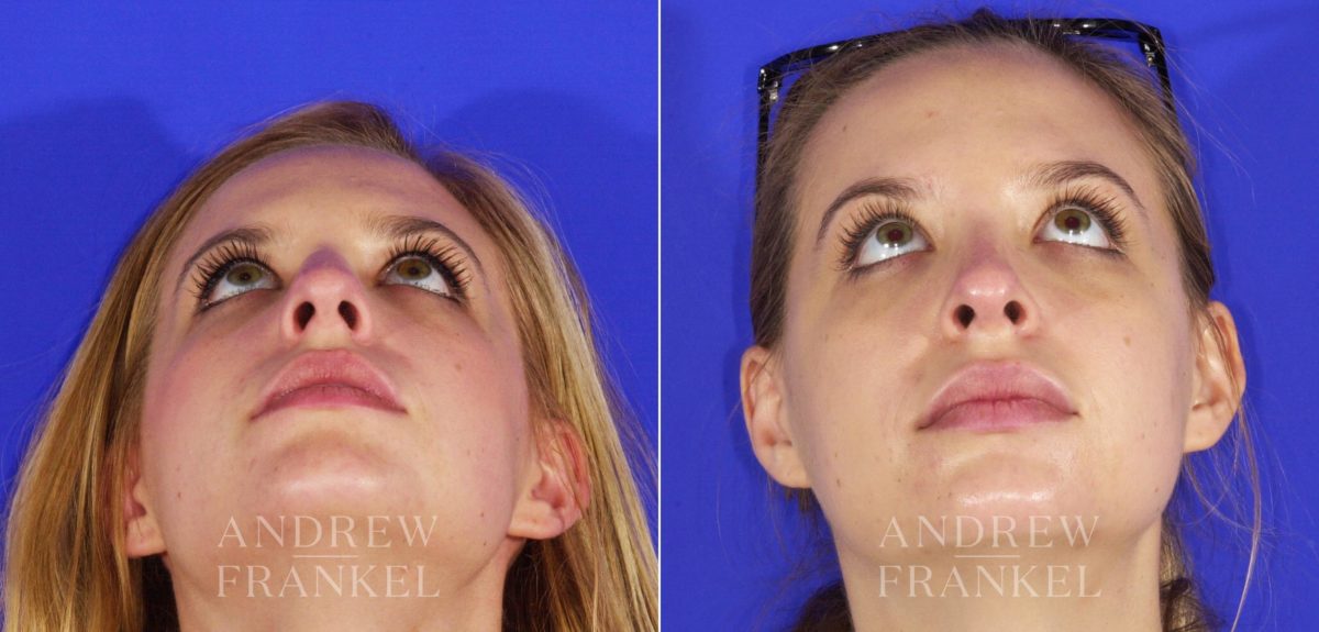Rhinoplasty before and after photos in Beverly Hills, CA, Patient 13344