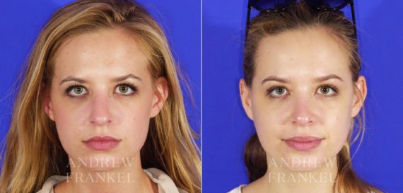 Rhinoplasty before and after photos in Beverly Hills, CA, Patient 13344