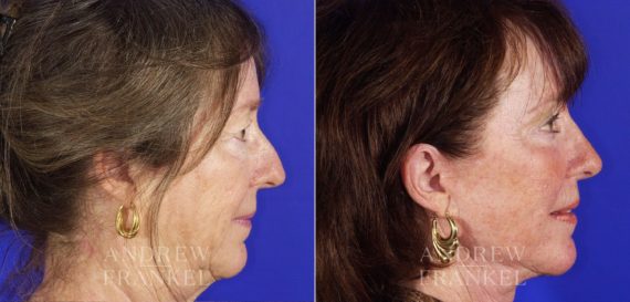 Rhinoplasty before and after photos in Beverly Hills, CA, Patient 13360