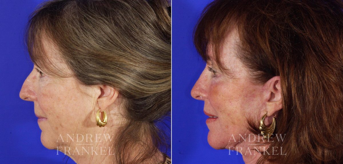 Rhinoplasty before and after photos in Beverly Hills, CA, Patient 13360