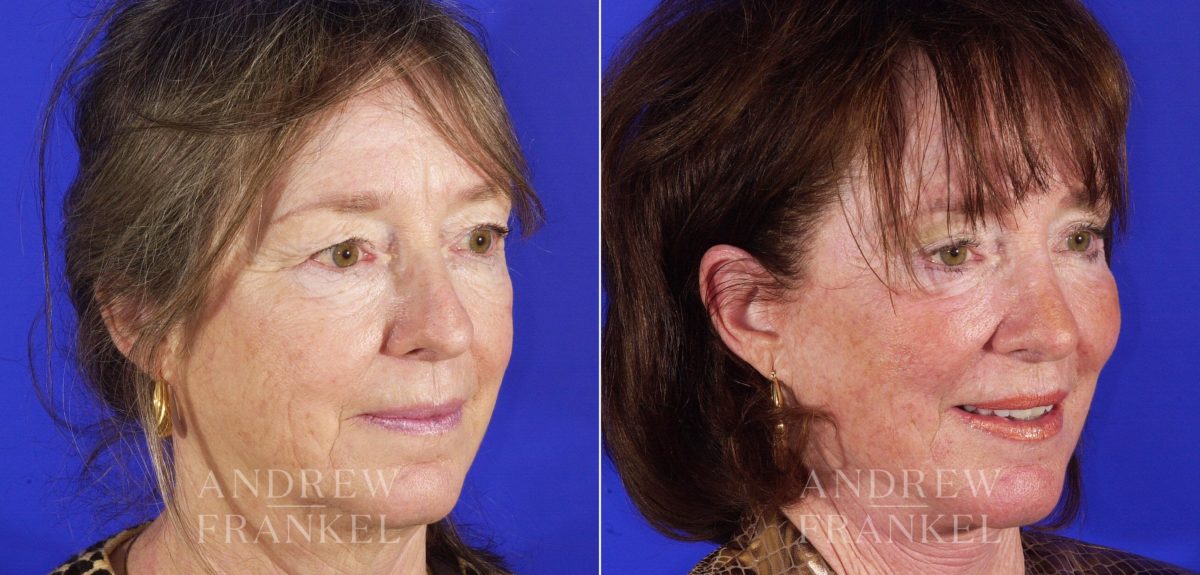 Rhinoplasty before and after photos in Beverly Hills, CA, Patient 13360