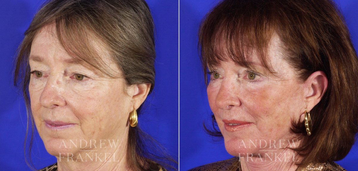 Rhinoplasty before and after photos in Beverly Hills, CA, Patient 13360