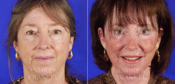 Rhinoplasty before and after photos in Beverly Hills, CA, Patient 13360