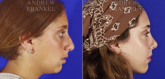 Jawline Contouring before and after photos in Beverly Hills, CA, Patient 14546