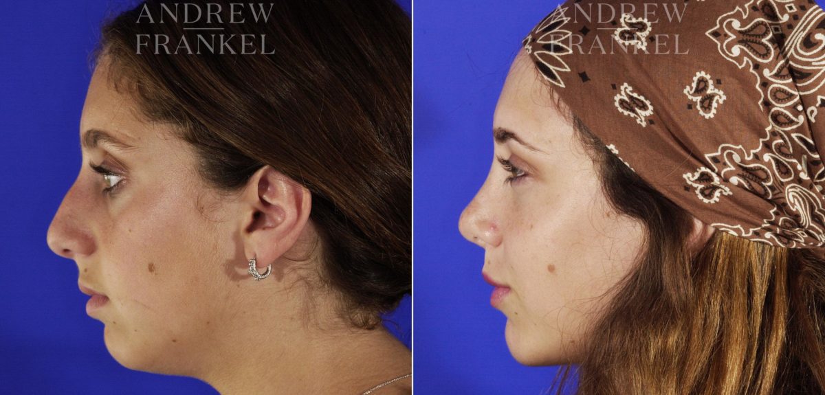 Jawline Contouring before and after photos in Beverly Hills, CA, Patient 14546