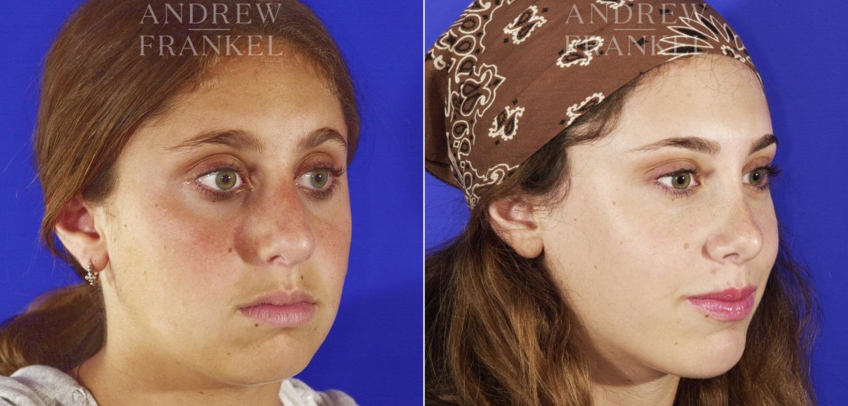 Jawline Contouring before and after photos in Beverly Hills, CA, Patient 14546
