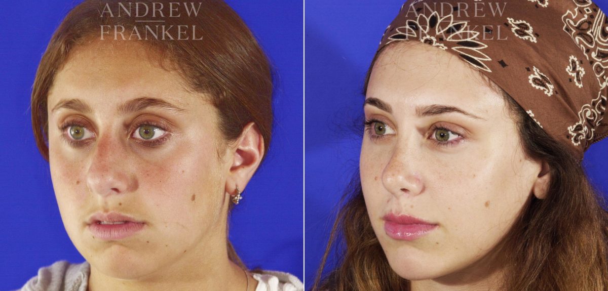 Jawline Contouring before and after photos in Beverly Hills, CA, Patient 14546