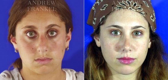 Jawline Contouring before and after photos in Beverly Hills, CA, Patient 14546