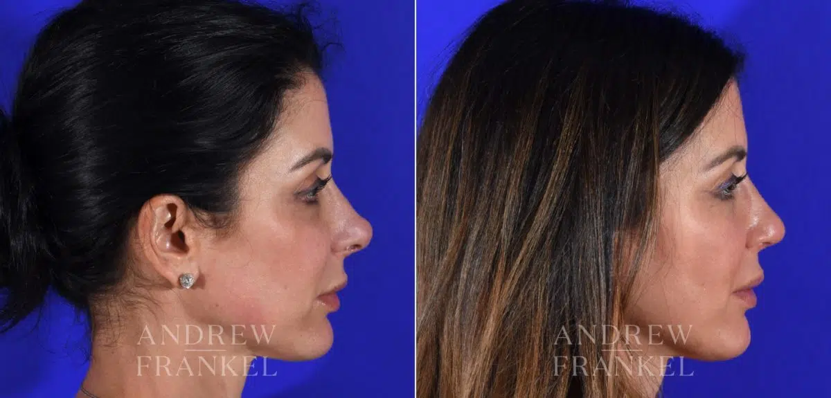 Revision Rhinoplasty before and after photos in Beverly Hills, CA, Patient 15115