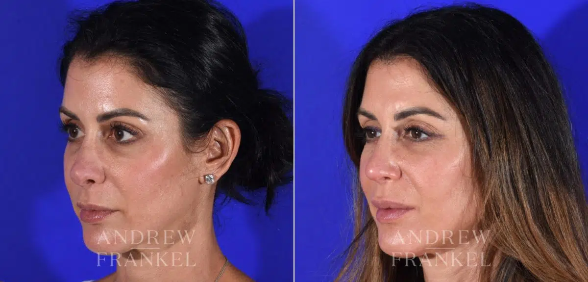 Revision Rhinoplasty before and after photos in Beverly Hills, CA, Patient 15115