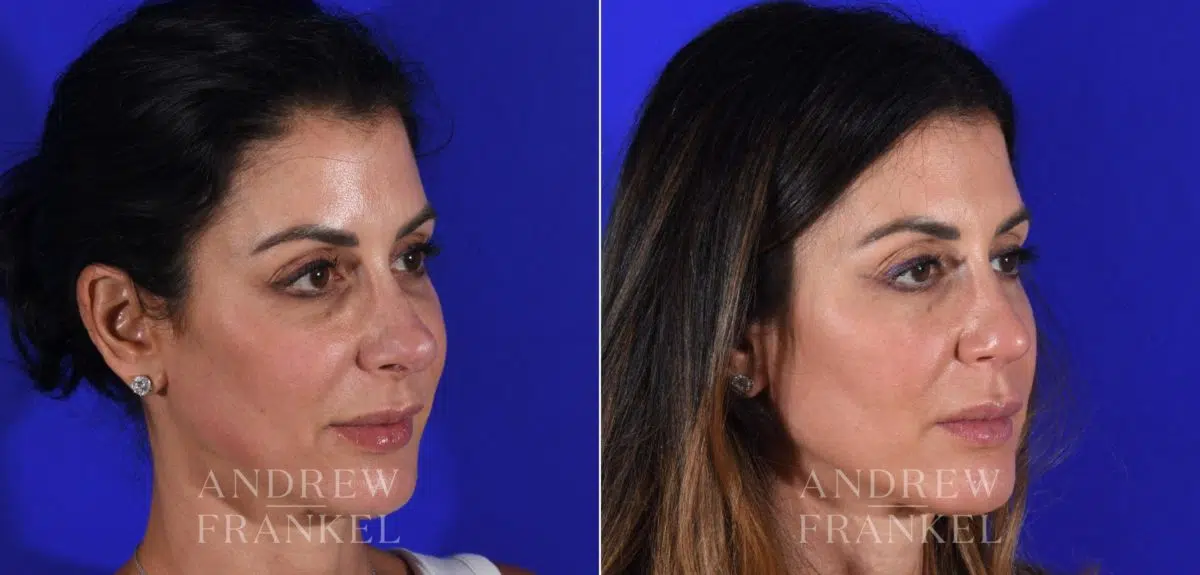 Revision Rhinoplasty before and after photos in Beverly Hills, CA, Patient 15115