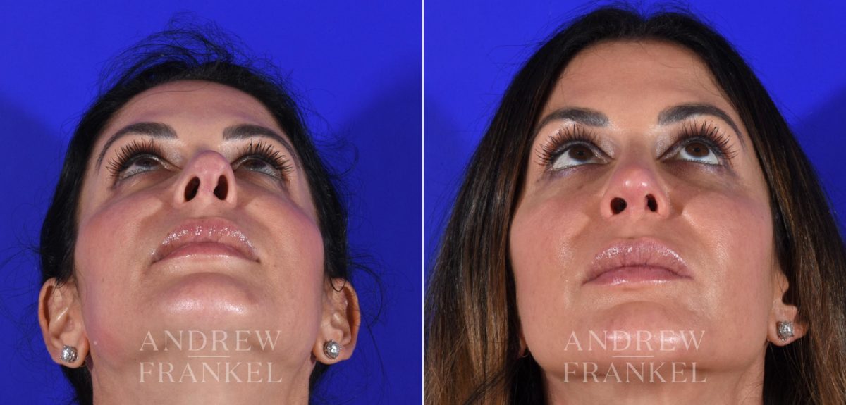 Revision Rhinoplasty before and after photos in Beverly Hills, CA, Patient 15115