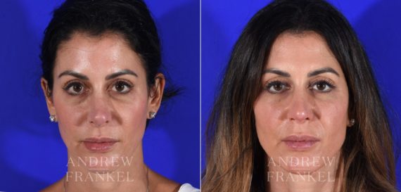 Revision Rhinoplasty before and after photos in Beverly Hills, CA, Patient 15115