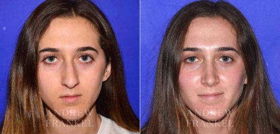 Rhinoplasty before and after photos in Beverly Hills, CA, Patient 15200