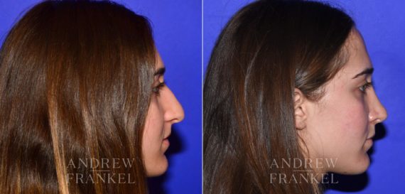 Rhinoplasty before and after photos in Beverly Hills, CA, Patient 15200