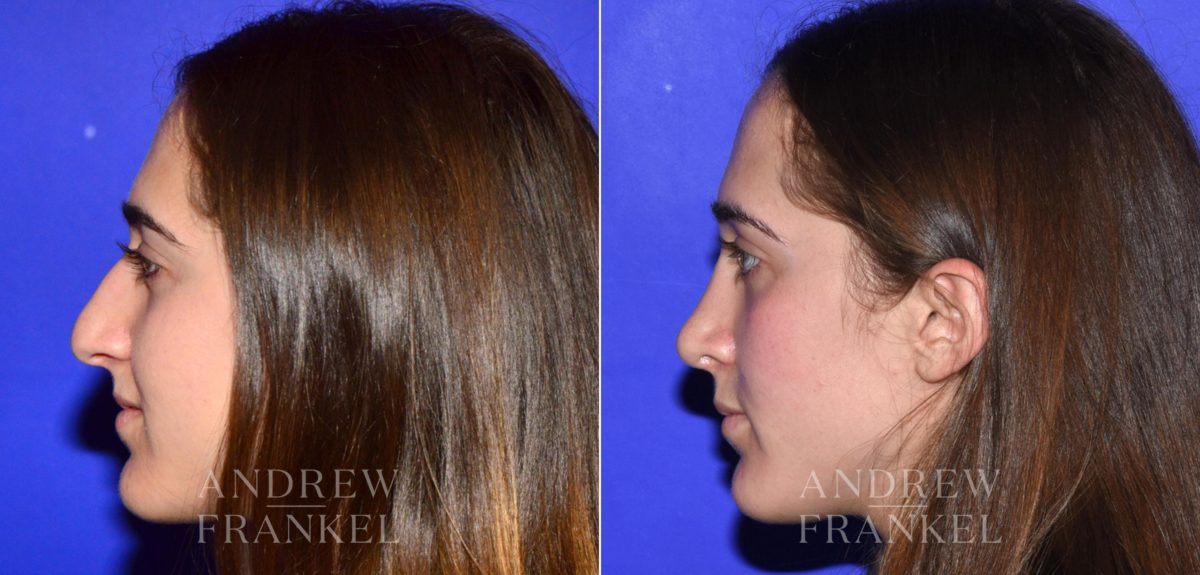 Rhinoplasty before and after photos in Beverly Hills, CA, Patient 15200