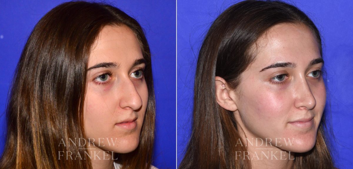 Rhinoplasty before and after photos in Beverly Hills, CA, Patient 15200